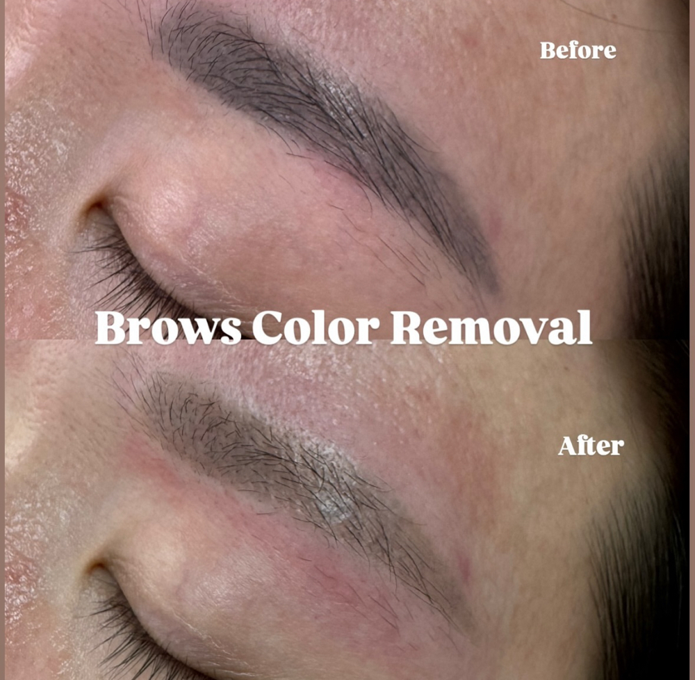 Brow Tatoo Removal at AlbaGlow Studio in Paramus, NJ