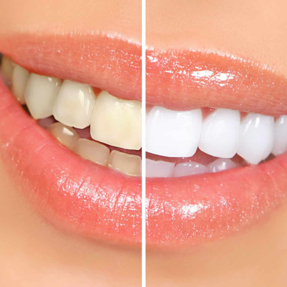 Cosmetic Teeth Whitening at Bottumzup Health and Wellness,LLC in Davenport, FL