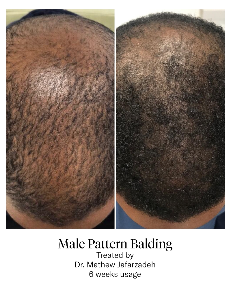 6-week Hair Restoration