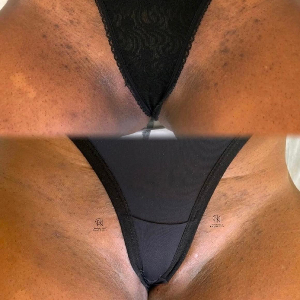 Clareamento Virilha at Jessica Luchesi Skin Wellness in Elizabeth, NJ