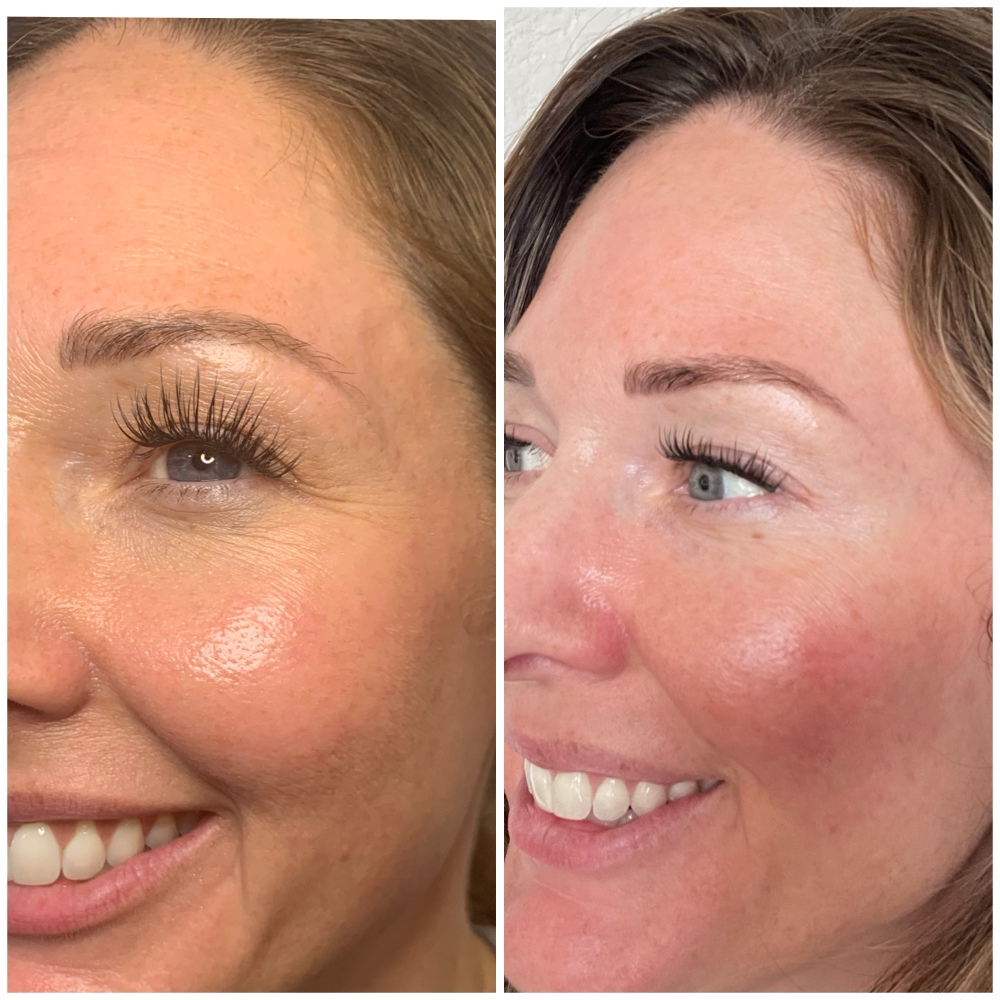 Botox/Dysport/Xeomin Follow Up