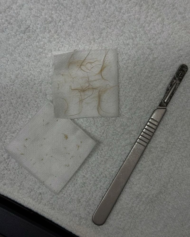 Add-On Dermaplane