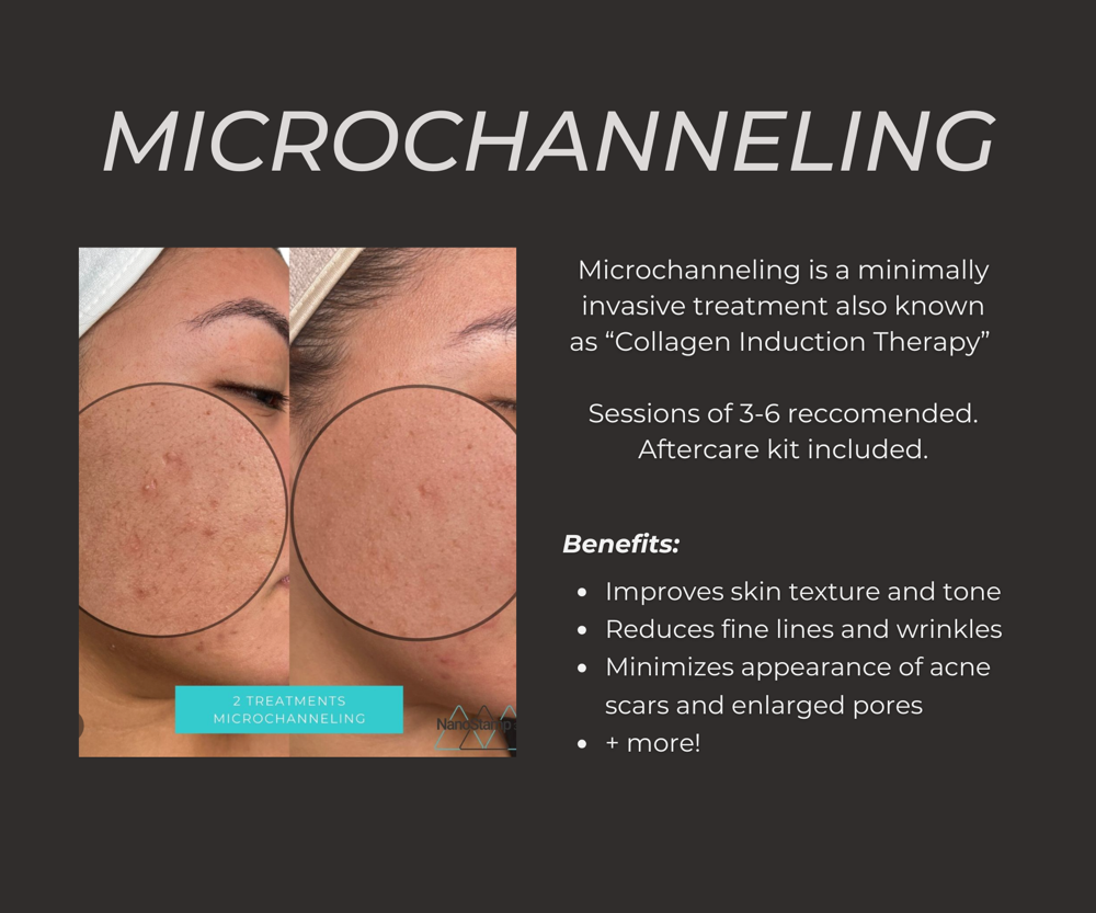 NanoStamp360 Microchanneling