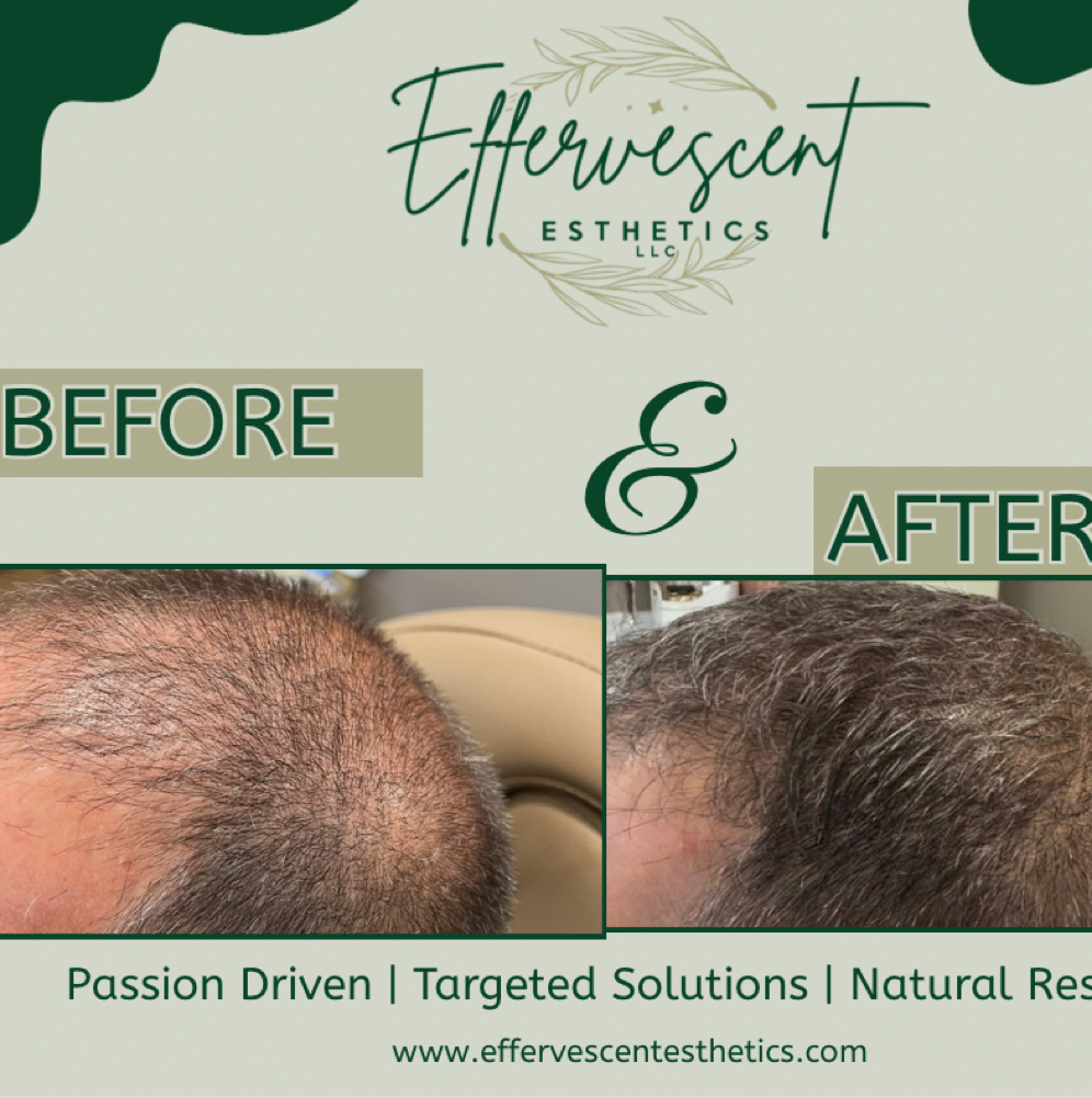 PRP Hair Restoration Treatment at Effervescent Esthetics in Freeport, IL