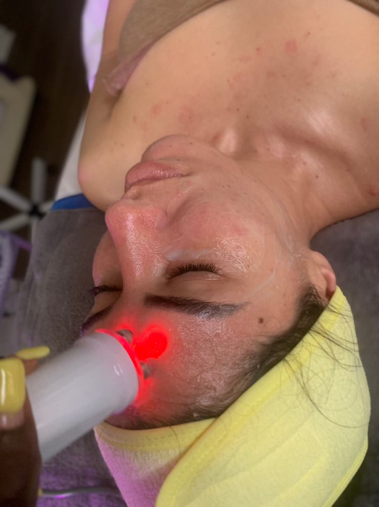 Radio Frequency Facial