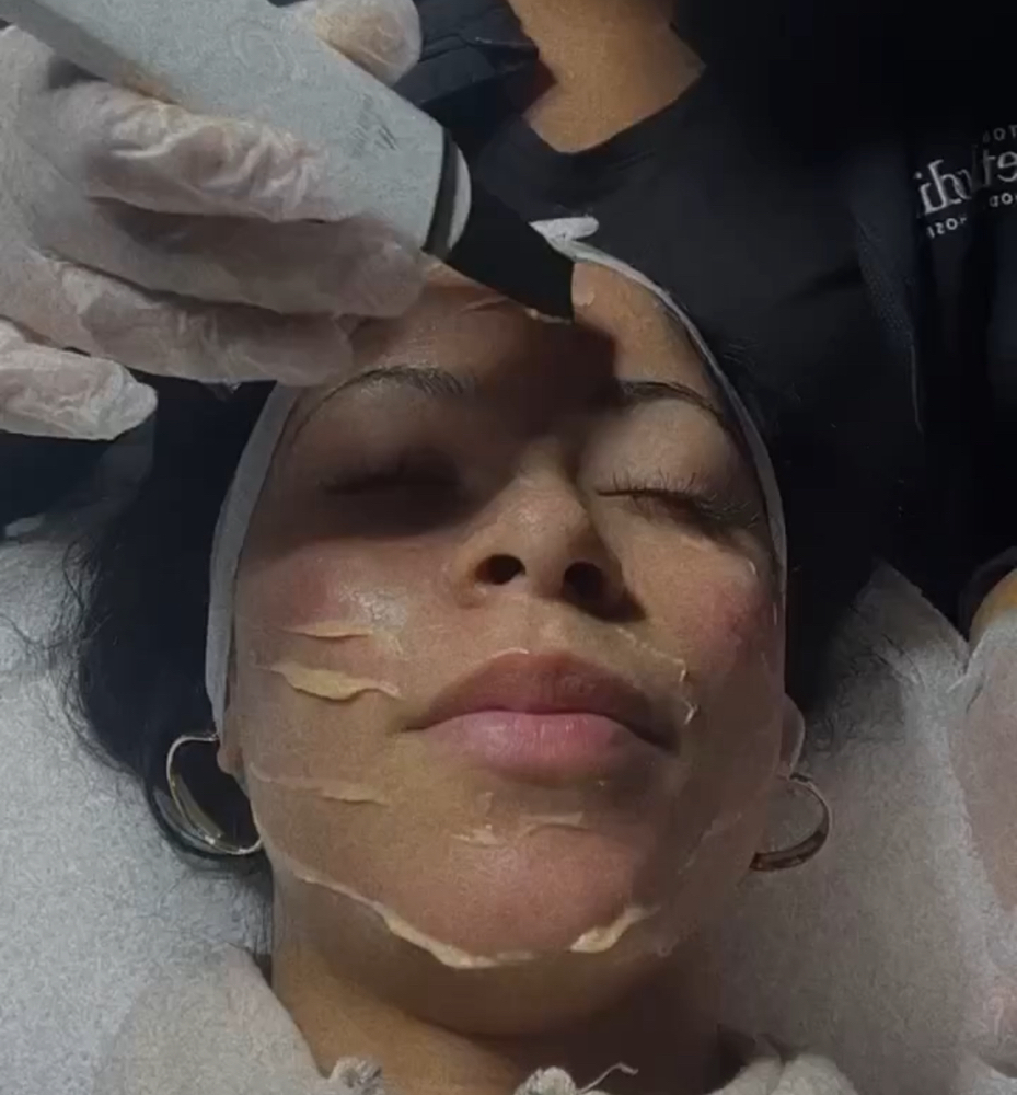 Acne Clarifying Facial at Esthetic By Beauti in Houston TX, TX