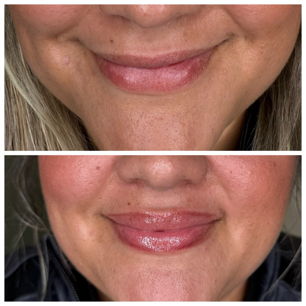 Lip Flip at Morena Aesthetics & Wellness in Kyle, TX