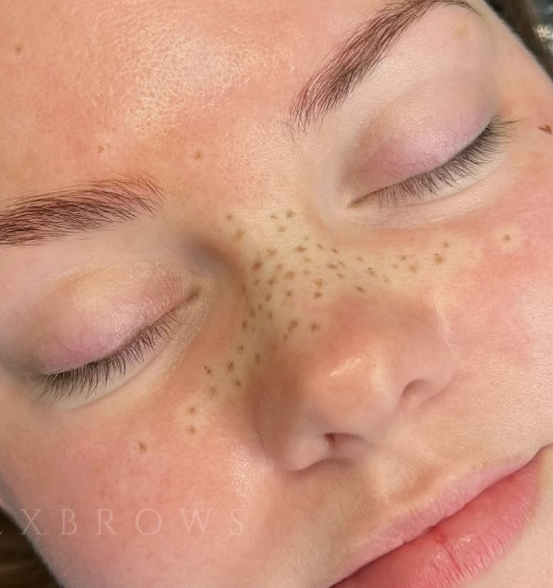 Permanent Freckles — Light Coverage