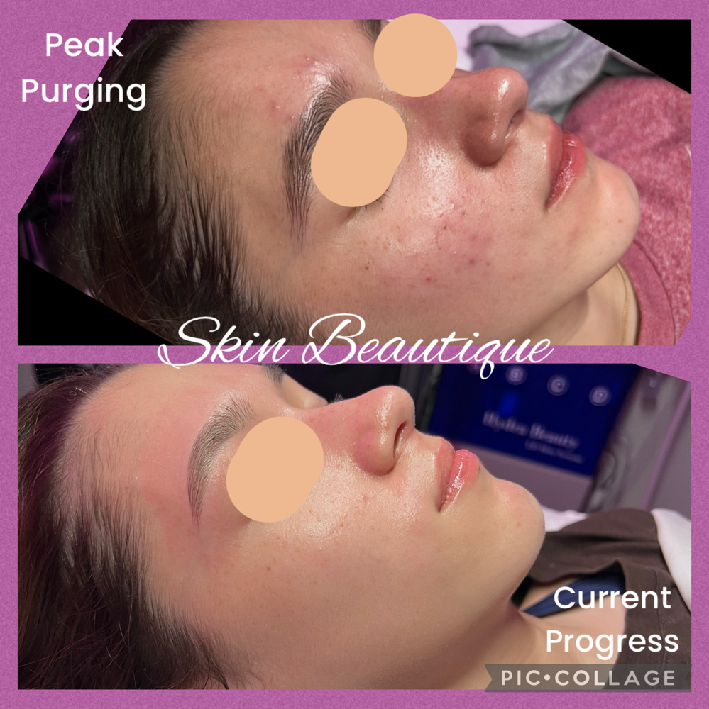 Teen Facial