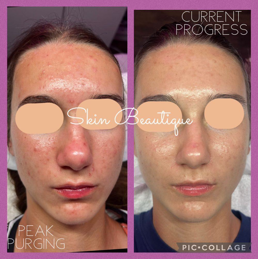 Teen Facial