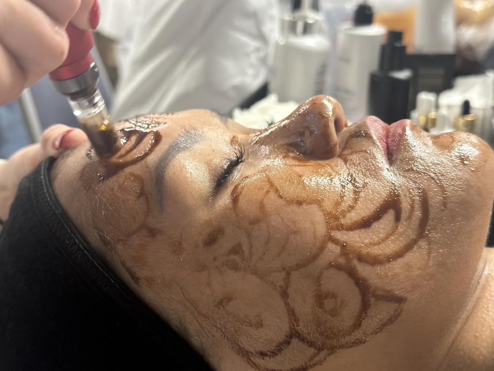 Micro Nano Needling