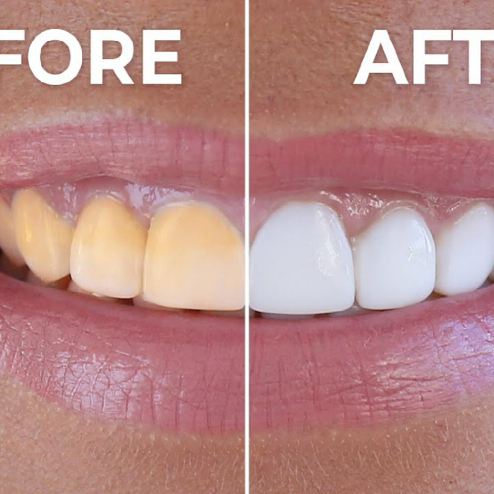 Teeth whitening at TheBrowBluePrintBabe in Lincoln, CA