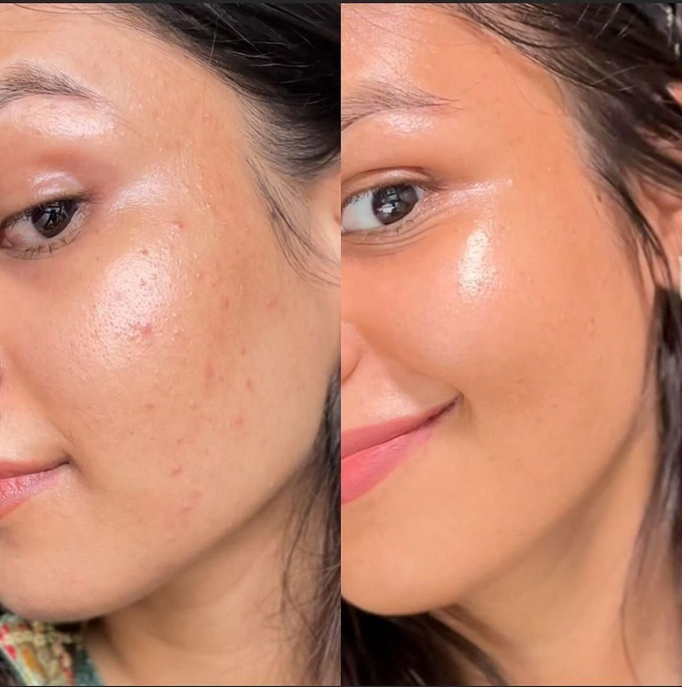 ACNE FACIAL TREATMENTS