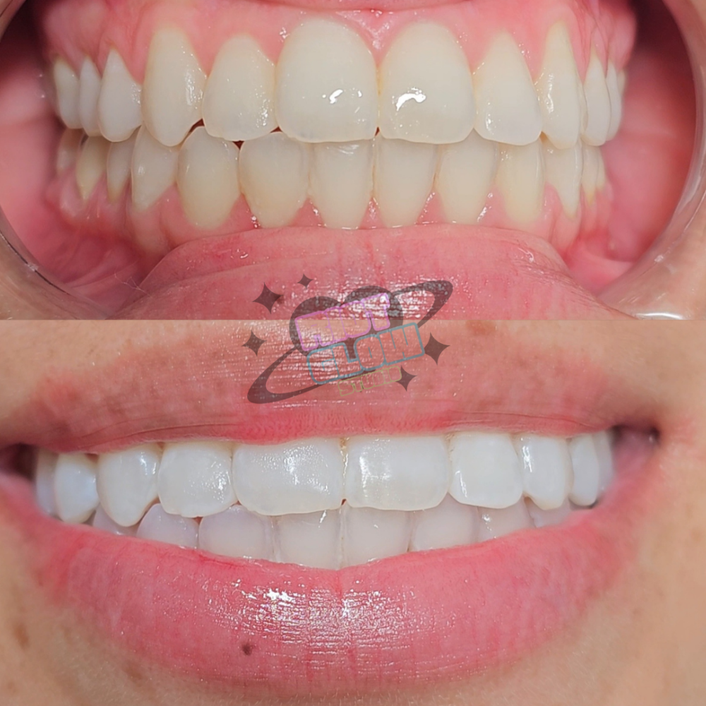 Teeth Whitening 60 Min