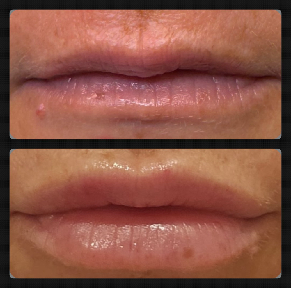 Lip Filler Half Syringe (0.5 mL)