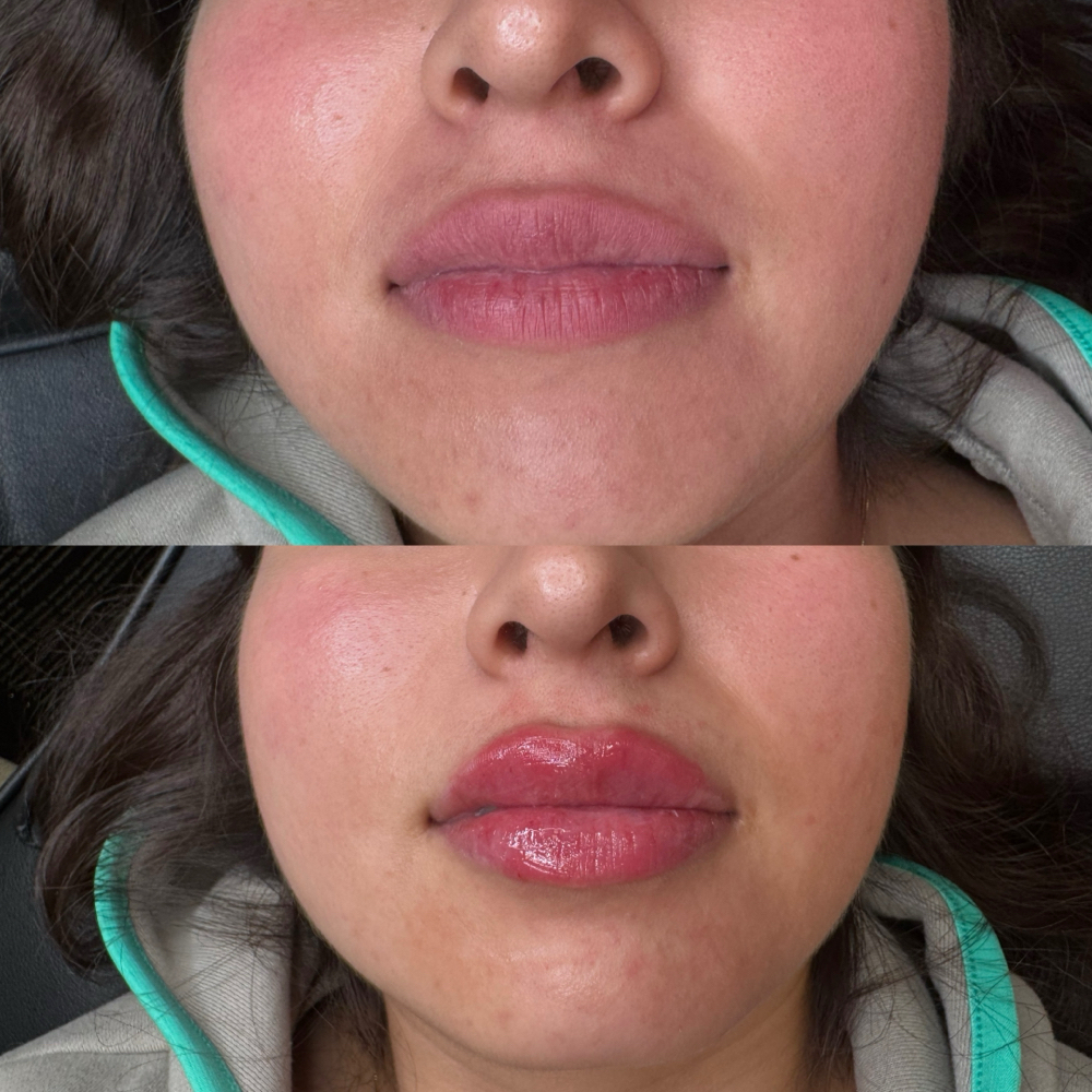 Lip Filler Half Syringe (0.5 mL) at Dvash Aesthetics in Lubbock, TX