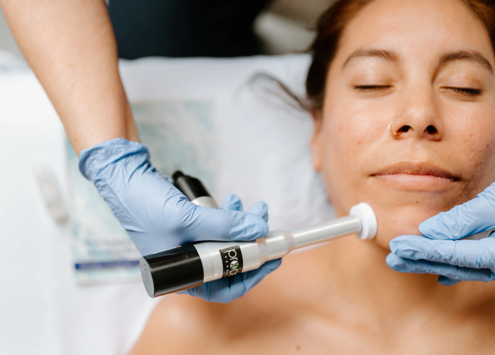 ProCell MD nano-needling at Estetica Venice