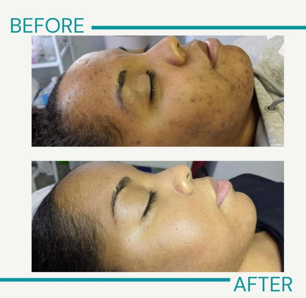 75 Mins Acne Facial