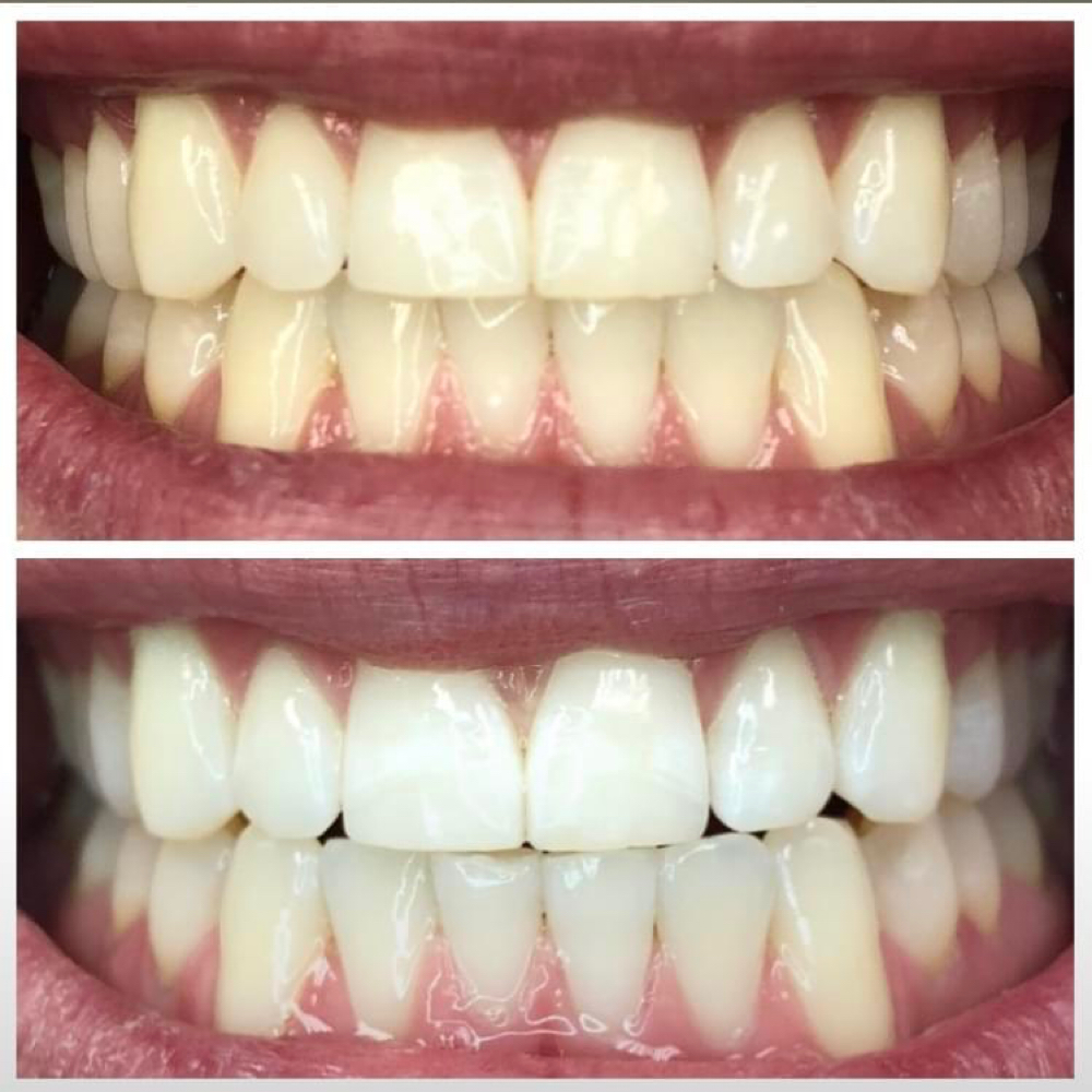 The Signature Whitening at Timeless Glow MN in St Cloud, MN