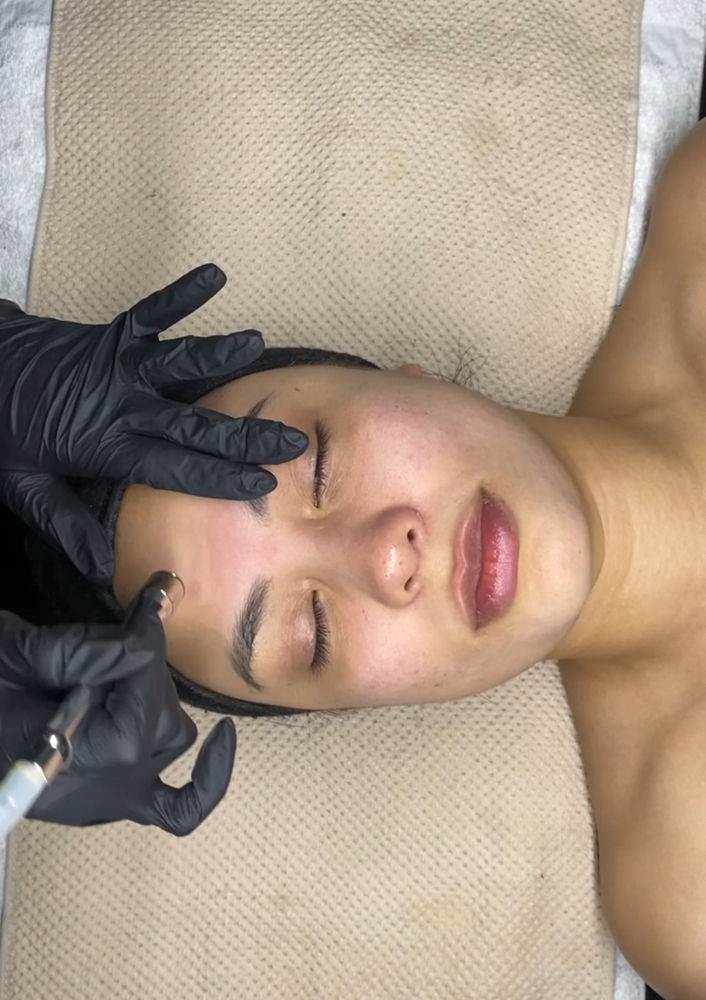 Microdermabrasion Facial