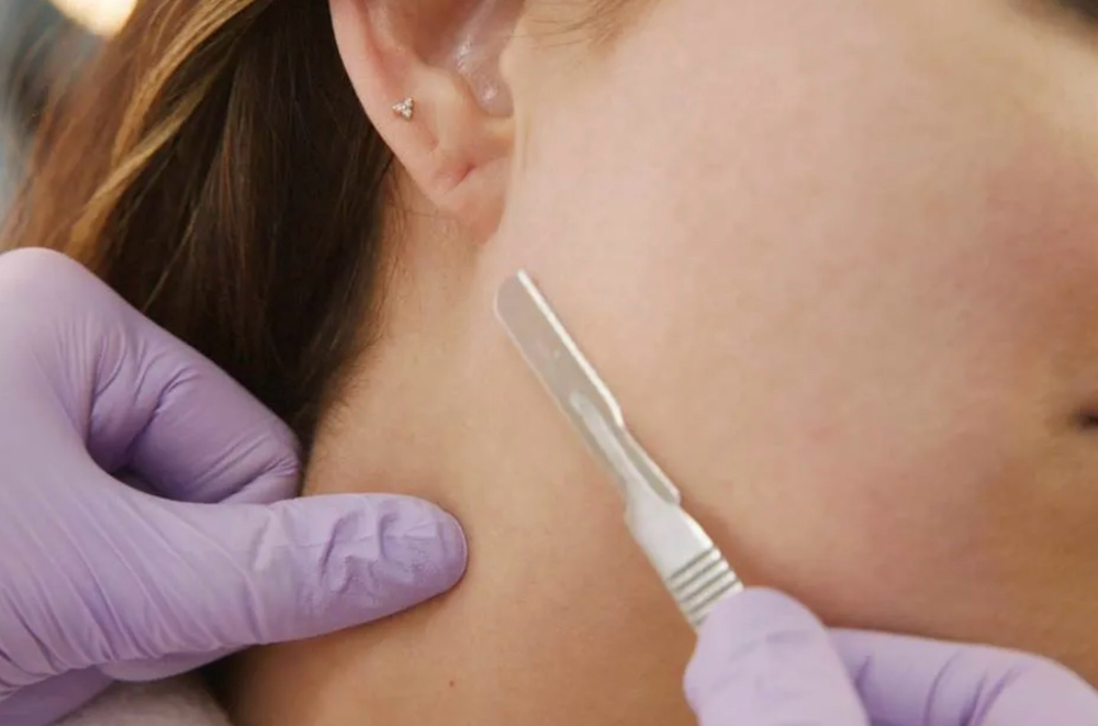 Dermaplaning