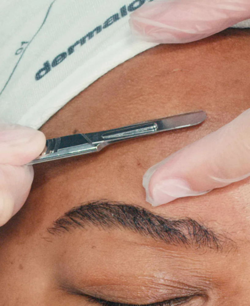Dermaplaning