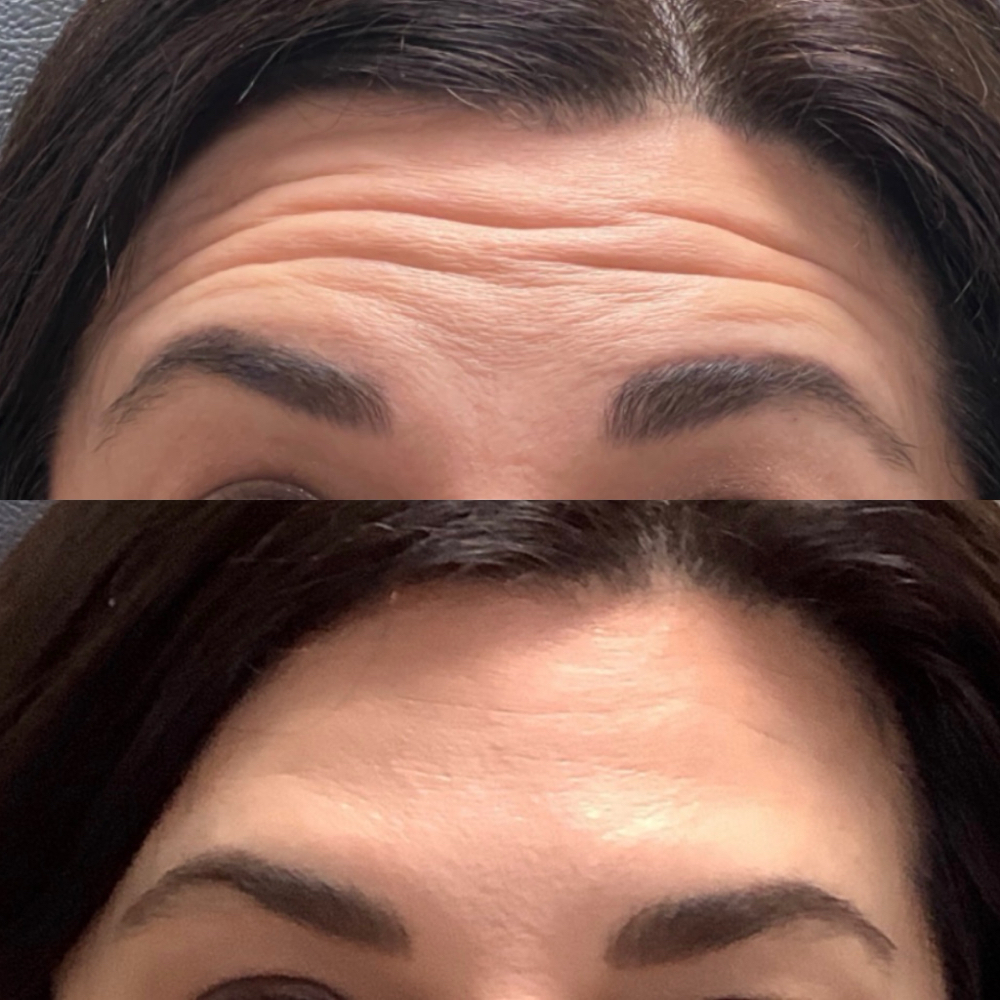 Tox- Frontalis (Forehead)