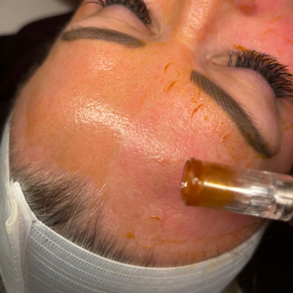 Nano Micro-Infusion Treatment at The Dermal Clinic in Lodi, CA