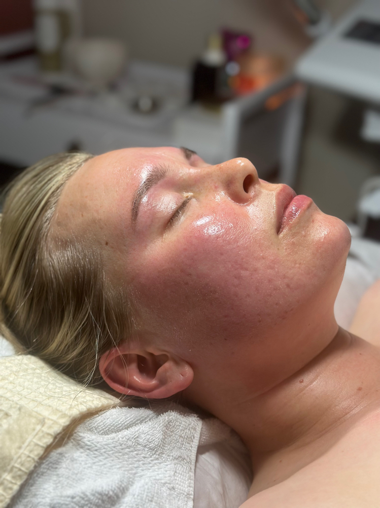 Chemical Peel Treatment