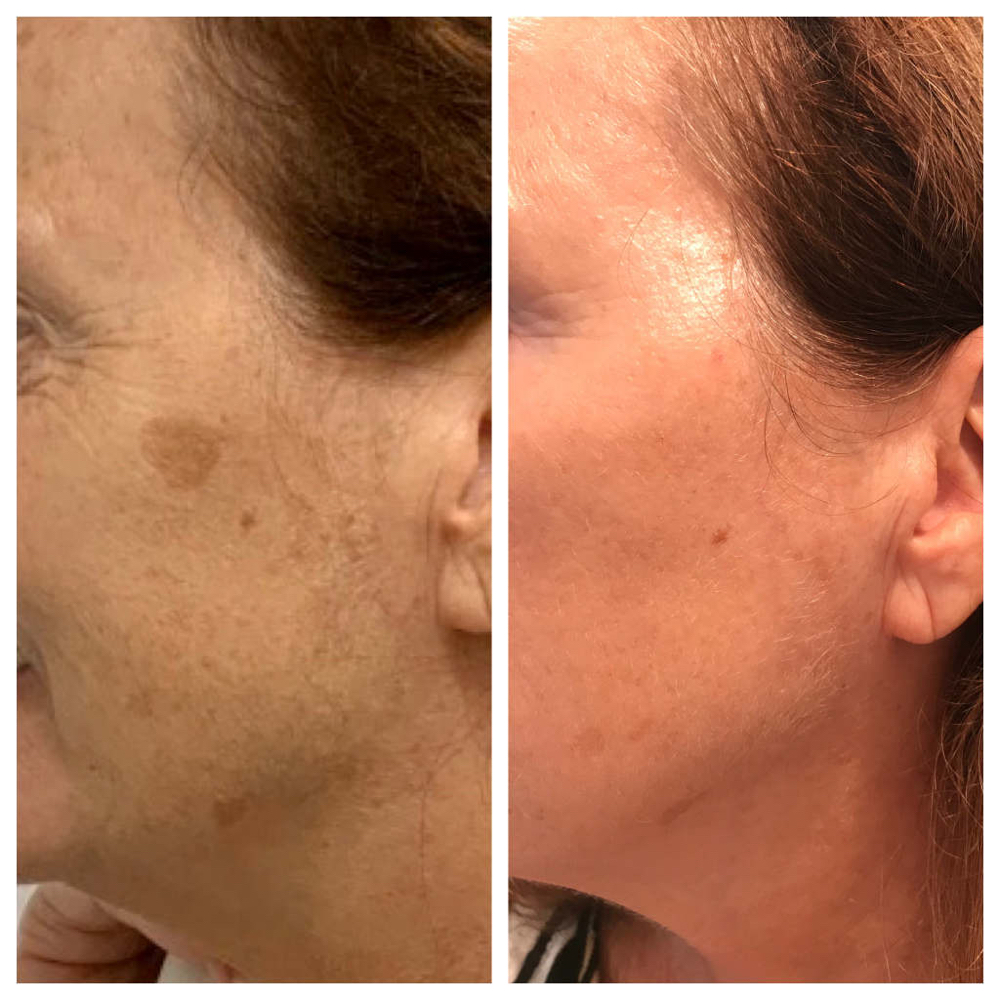 BIOREPEEL CHEMICAL PEEL