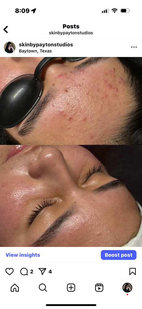 Acne Clearing Treatment