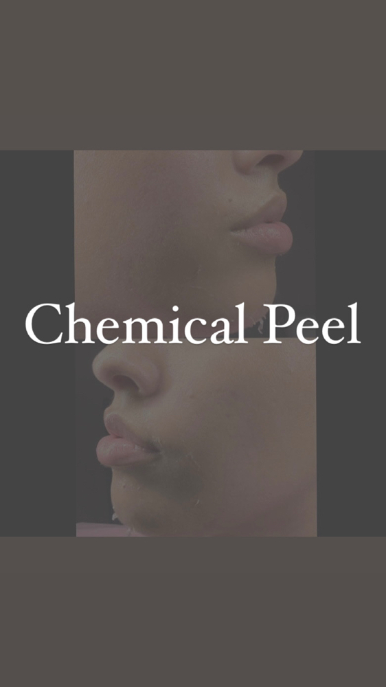 Chemical Peel Add On