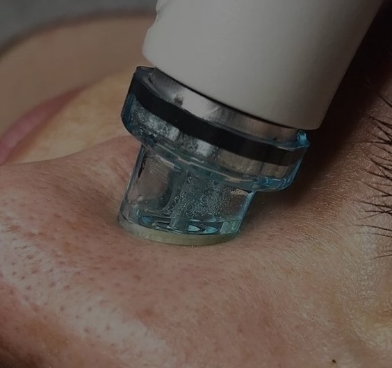 Extractions using Hydrafacial