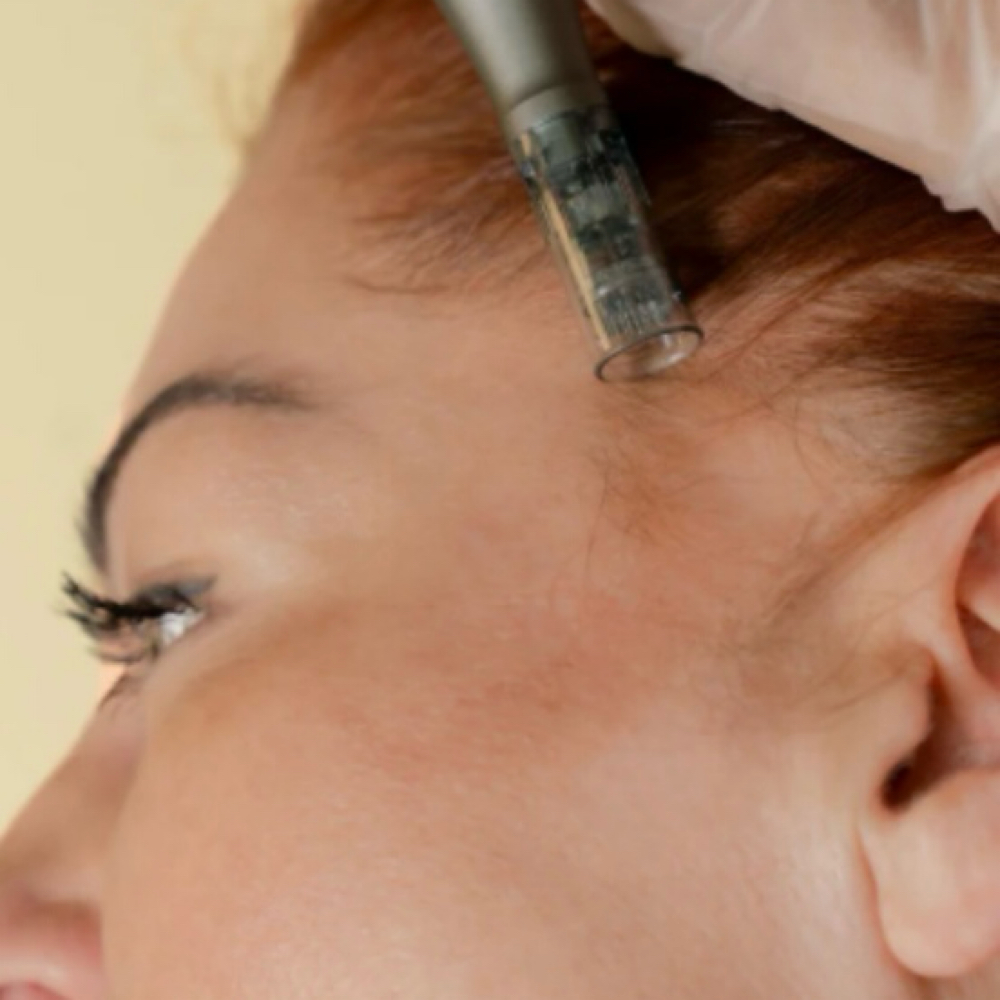 MicroNeedling HairRestore at HOUSE OF BEAUTY UTAH in St George, UT