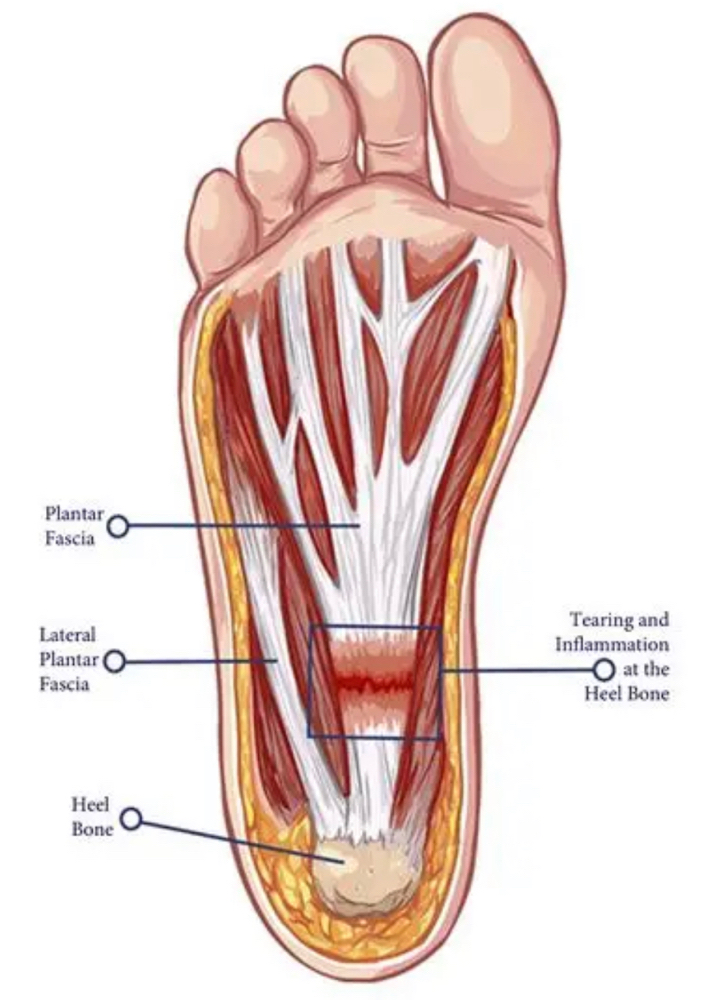 Plantar Fasciitis Treatment