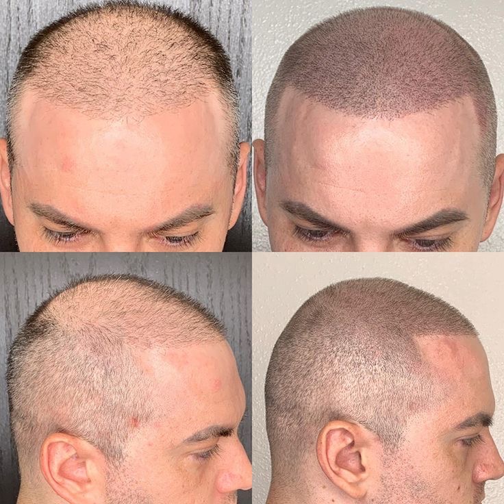 Scalp Pigmentation