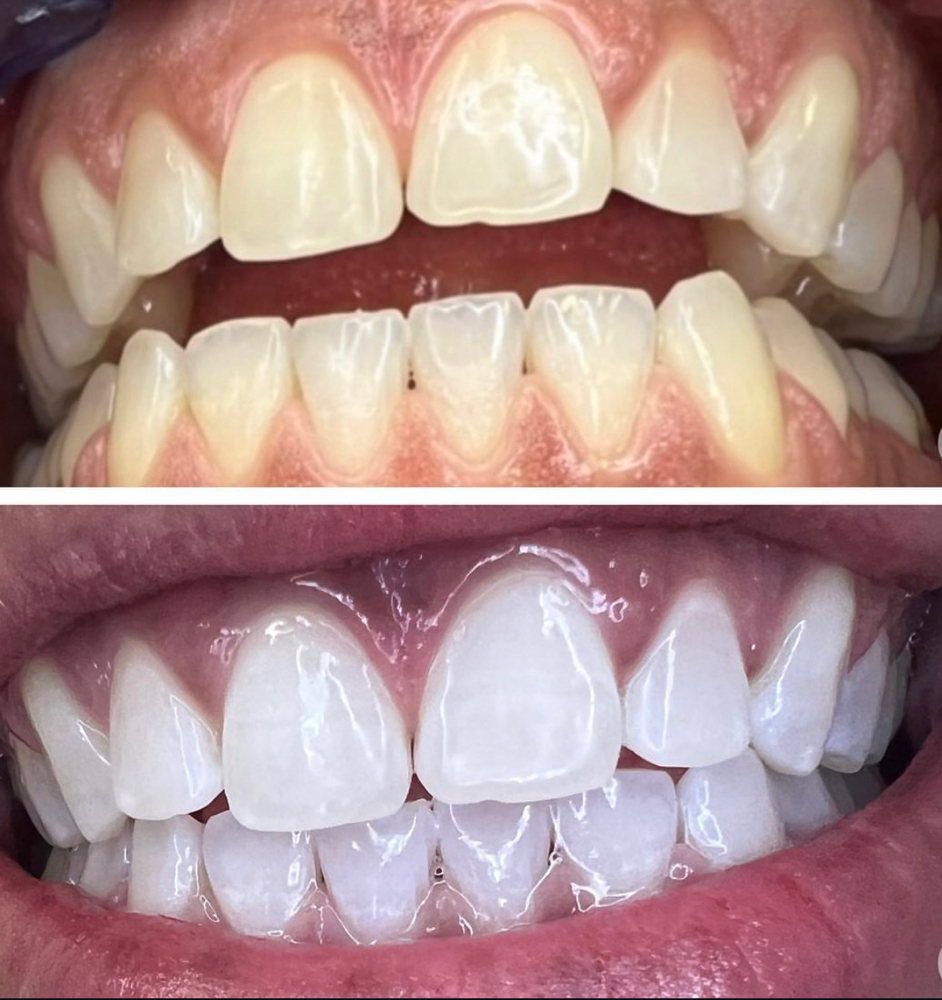 Pro Laser 90 Minute Teeth Whitening