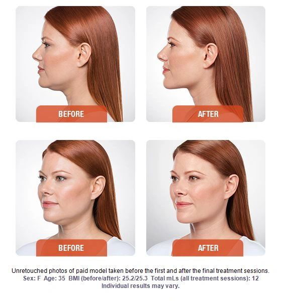 Kybella