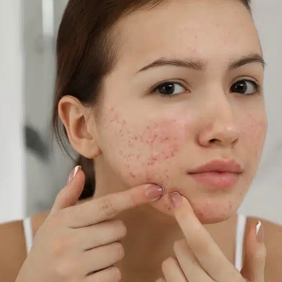 Acne Treatment (Advanced) at Golden State Glam in Fair Oaks, CA
