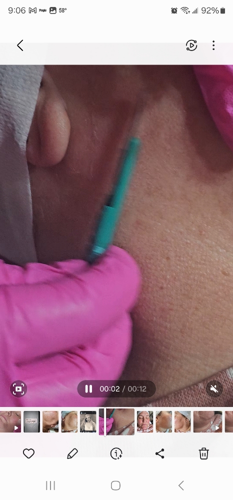 Dermaplaning