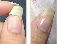 Nail Repair