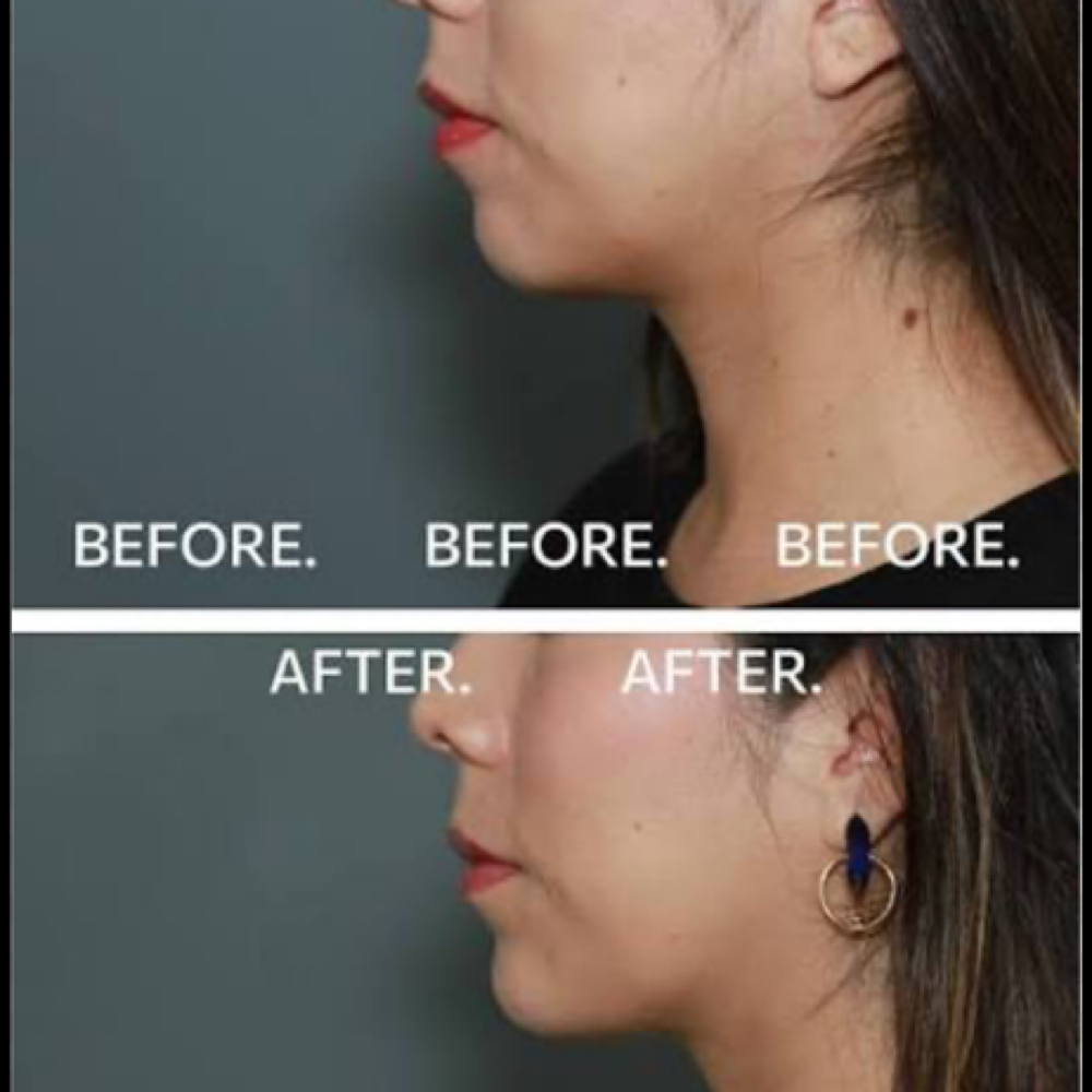 Chin Filler at Finesse Sculpt Body Studio LLC in Joppa, MD