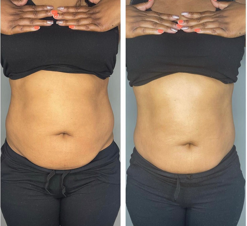 Body Sculpting Package Save 10%