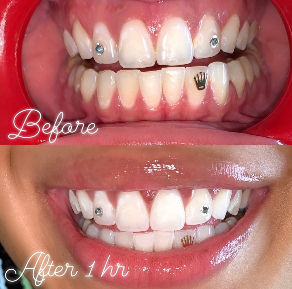 WHITEN AROUND GEM SET™