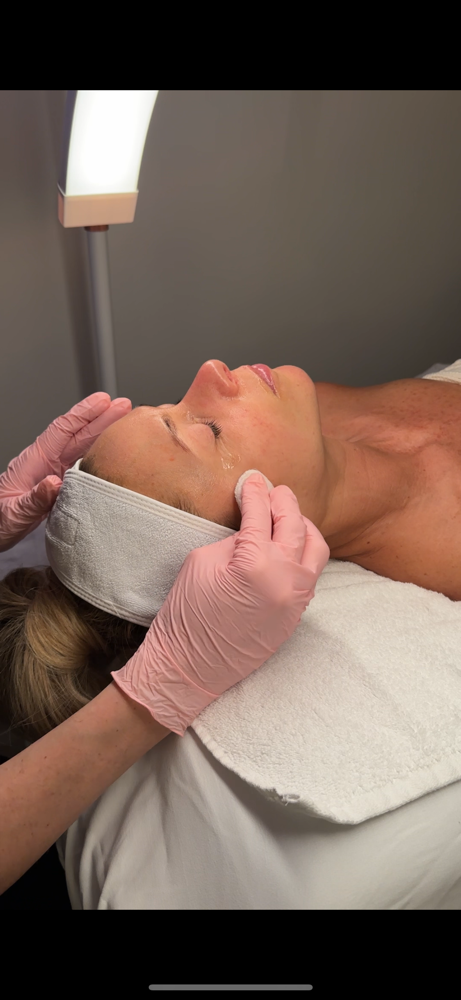Basic Chemical Peel