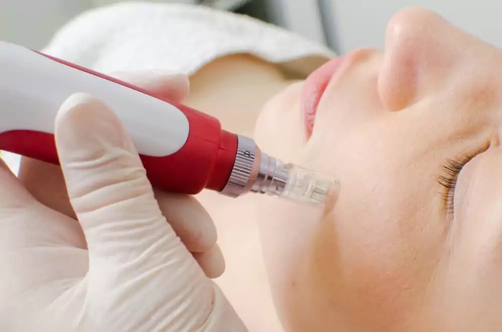 Microneedling Facial Add-On