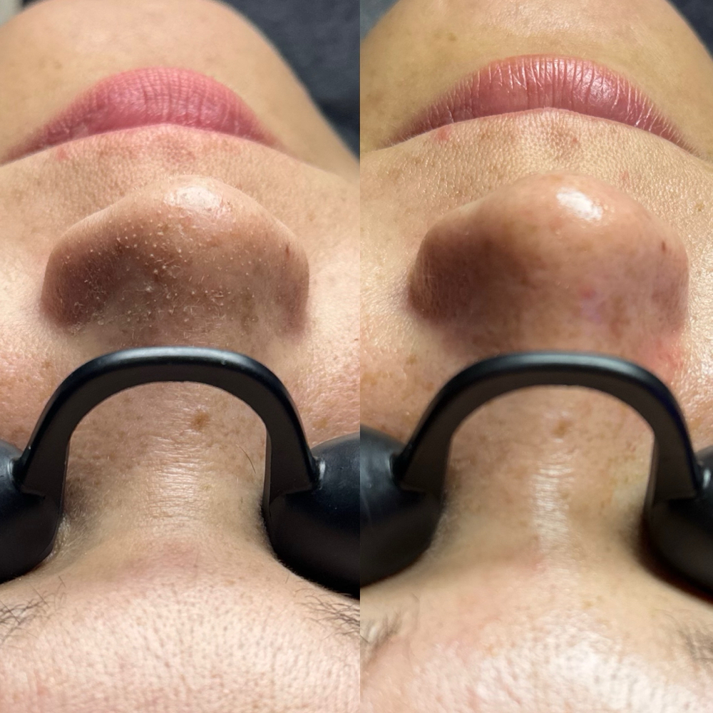 Dermaplane + Oxygen Facial