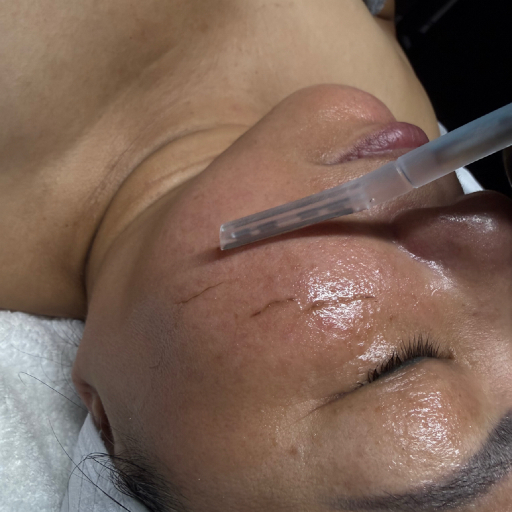Dermaplaning at The Glitz Skin Studio in San Antonio, TX