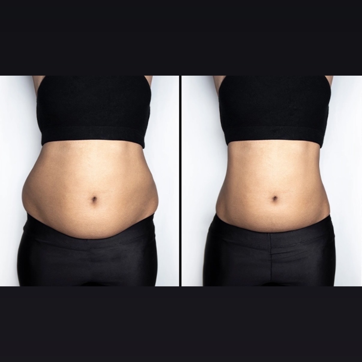 Lipo 360 Love Handles at Gold Stone Beauty in mcallen, TX