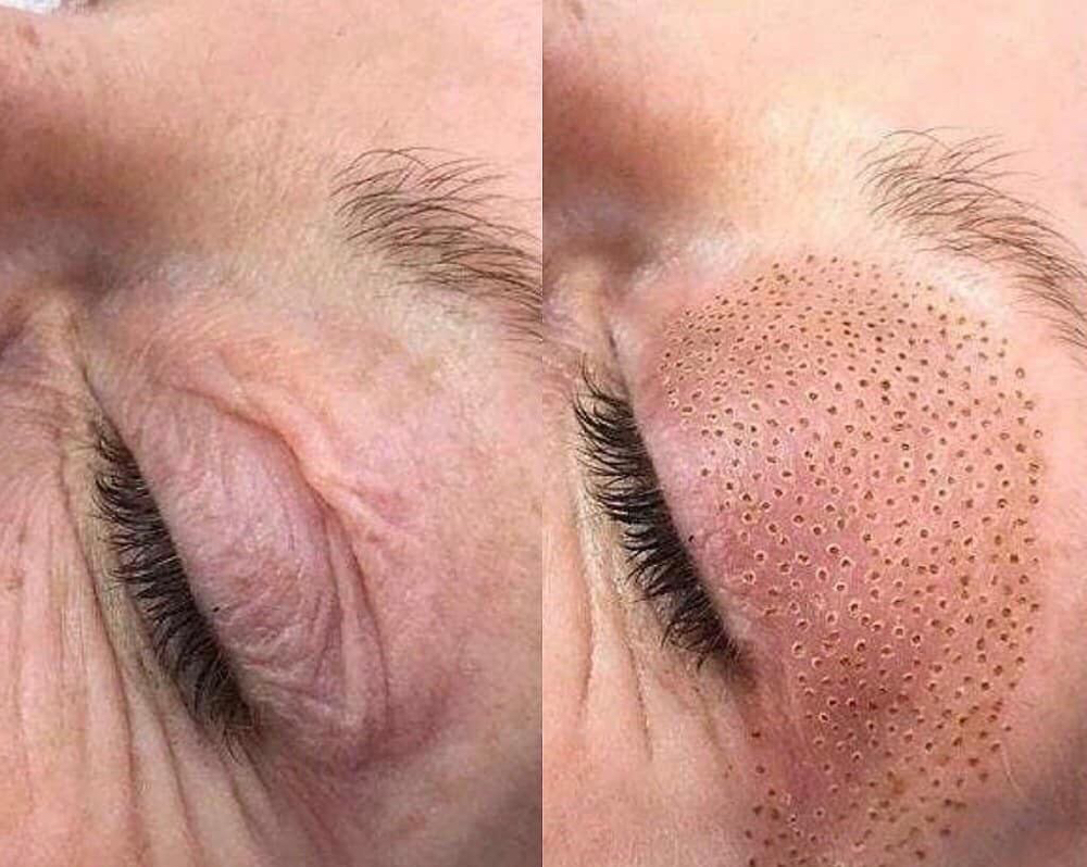 Skin Tightening  Upper Eye Lid